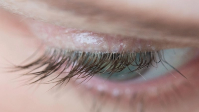 Demodex-Milben können Symptome eines trockenen Auges oder einer Lidrandentzündung auslösen. (Foto: Andrea Warnecke/dpa-tmn)