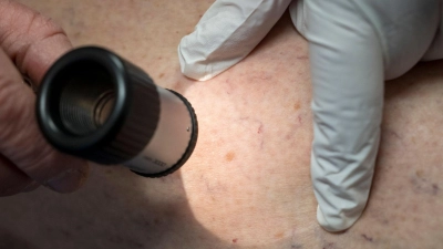 Die Zahl der Krankenhausbehandlungen von Hautkrebs stieg enorm an. (Symbolbild) (Foto: Peter Kneffel/dpa)