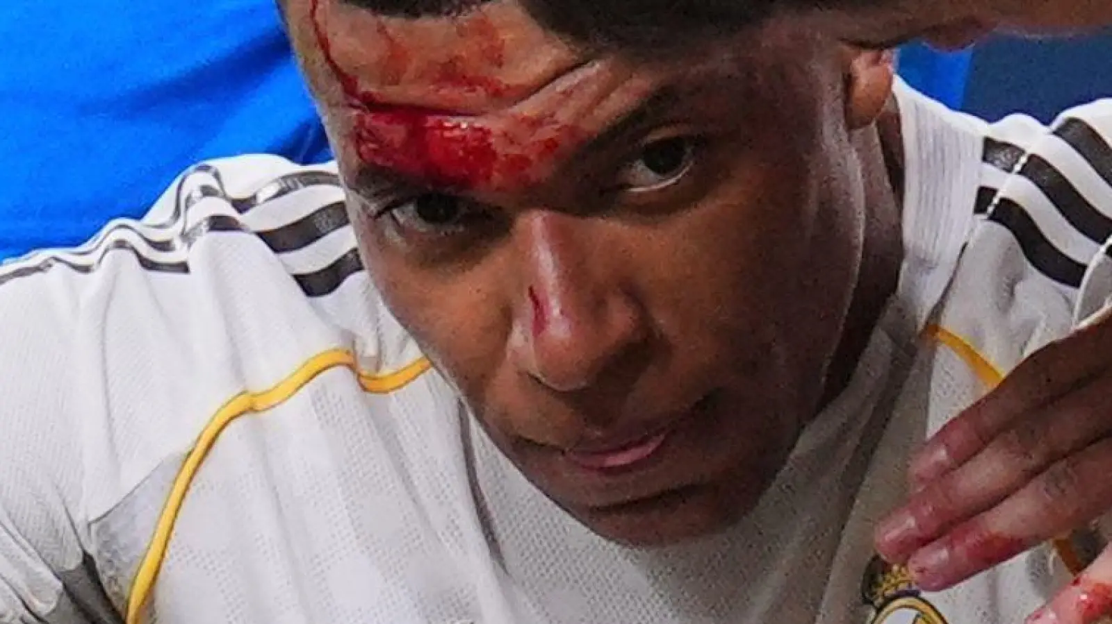 Kylian Mbappé wurde im Spiel gegen Girona im Gesicht getroffen. (Foto: Manu Fernandez/AP/dpa)