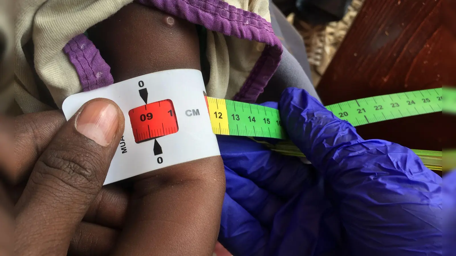 Schon jetzt gelten fast zwei Millionen Kinder in Somalia akut unterernährt. (Archivbild) (Foto: Eva-Maria Krafczyk/dpa)