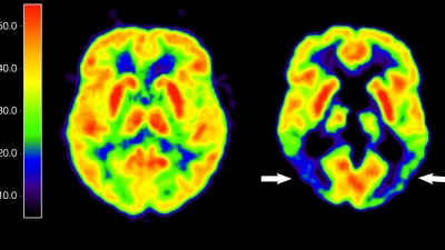 Entscheidung über die Zulassung für Medikament zur Behandlung von Alzheimer-Patienten verzögert sich. (Archivbild) (Foto: Lutz Kracht/MPI/dpa)