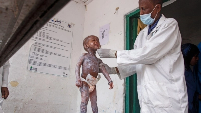 Ein Arzt im somalischen Mogadischu behandelt ein Kind, das Symptome einer schweren Eiweißunterernährung zeigt. In der von einer massiven Dürre gebeutelten Region ist es bereits zu ersten Todesfällen gekommen. (Foto: Farah Abdi Warsameh/AP/dpa)