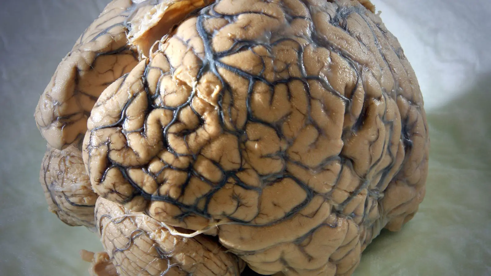 Ein Gehirn des Menschen in einem Labor der Klinik für Neurologie am Universitätsklinikum Jena. (Foto: Jan-Peter Kasper/dpa-Zentralbild/dpa)