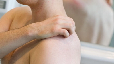 Dermatophilose, auch Regenfäule genannt, ist eine seltene, sexuell übertragbare Hautinfektion. (Foto: Friso Gentsch/dpa/dpa-tmn)