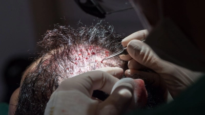 Unter bestimmten Voraussetzungen können die Kosten einer Haartransplantation steuerlich geltend gemacht werden. (Foto: Andrea Warnecke/dpa-tmn)