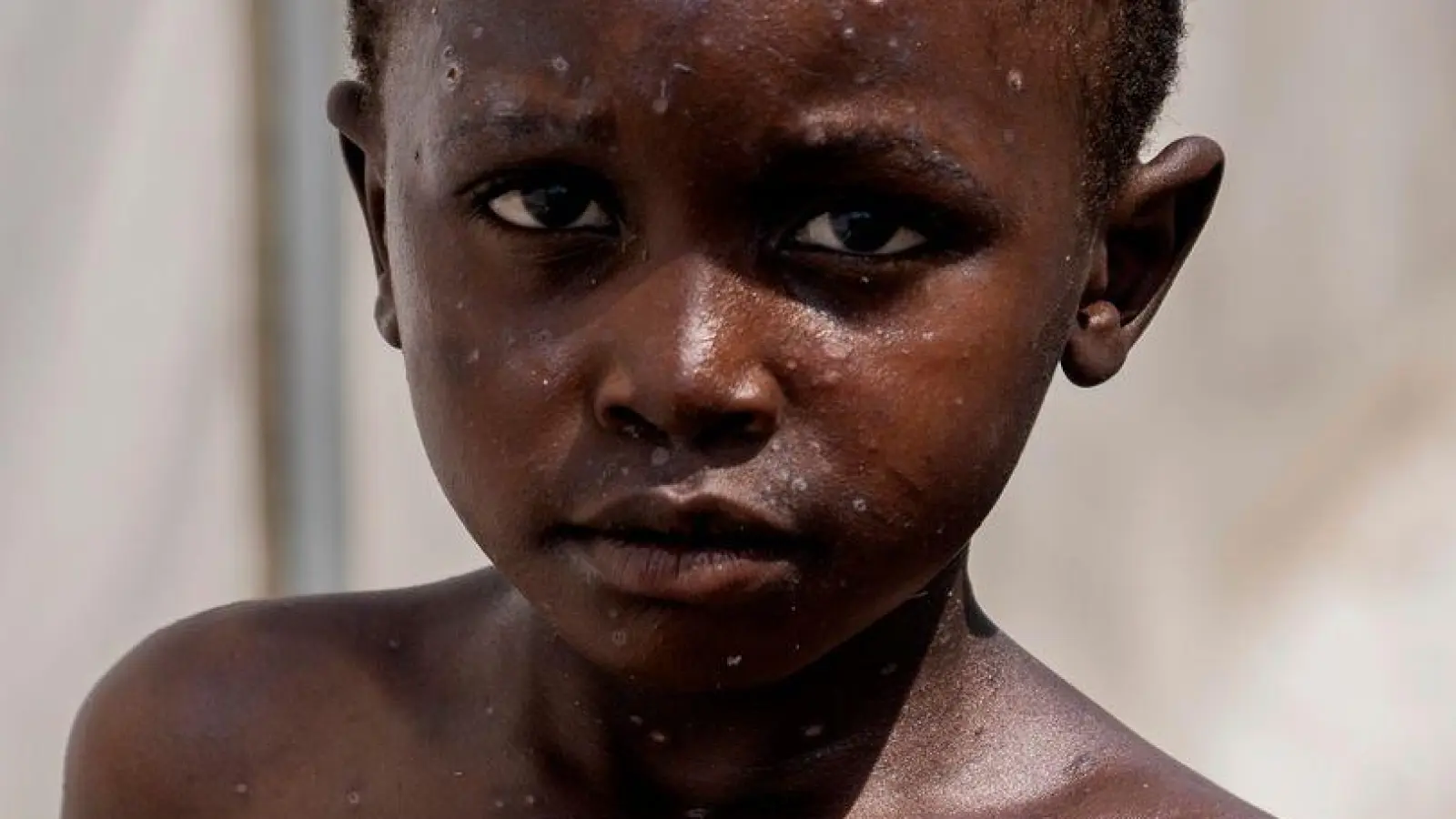 Für Kinder kann Mpox besonders gefährlich sein (Archivbild)  (Foto: Moses Sawasawa/AP/dpa)