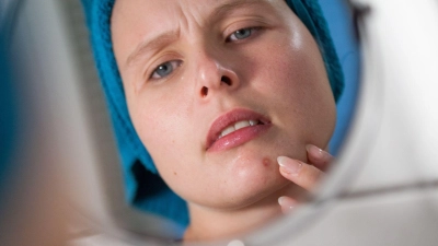 Mist, ein Pickel! Durch vermehrte Talgproduktion können Poren verstopfen und sich entzünden. Das stört viele nicht nur optisch, sondern tut manchmal auch richtig weh.  (Foto: Christin Klose/dpa-tmn)