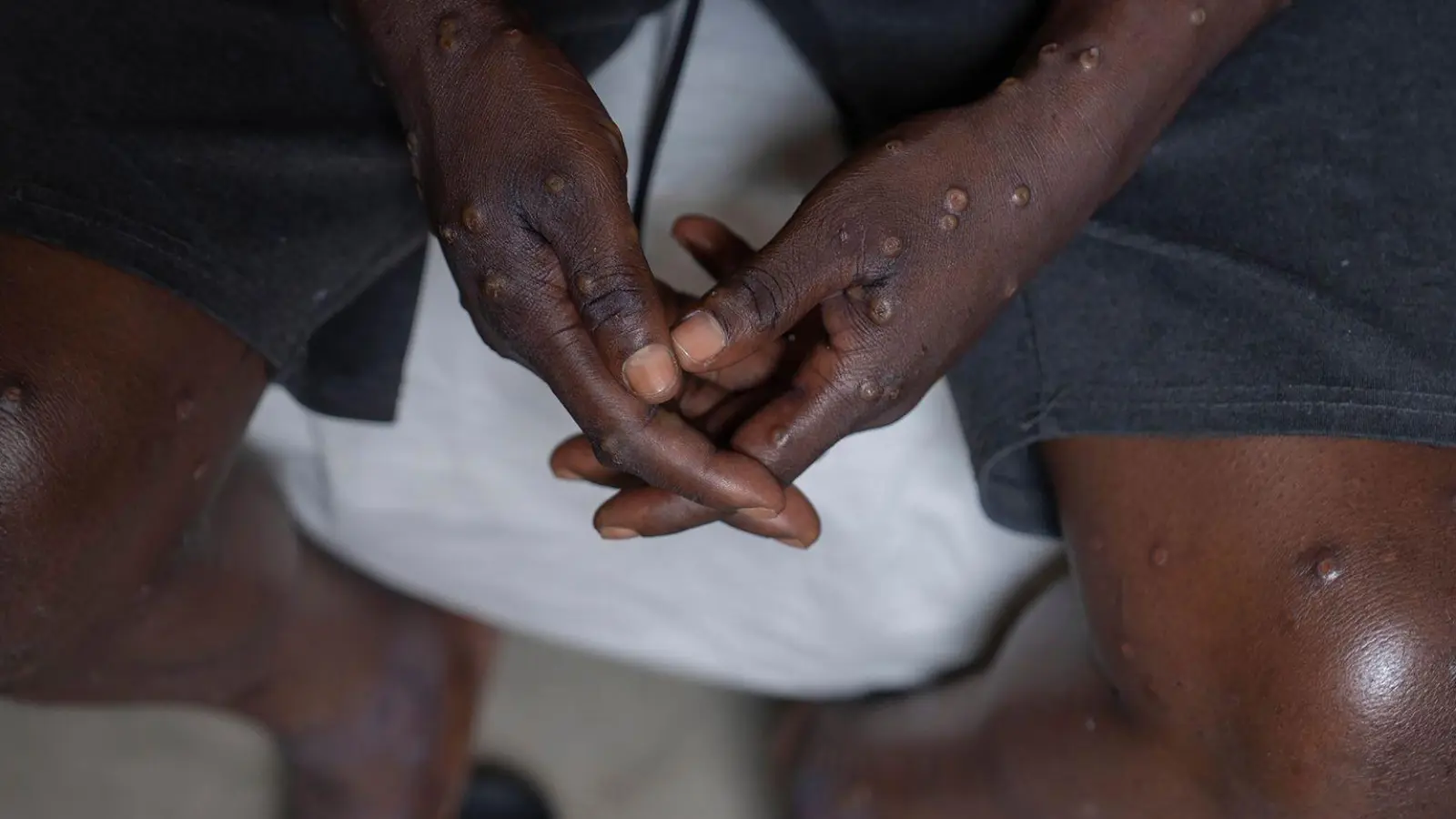 Mehrere Mpox-Ausbrüche in Afrika und eine neue womöglich gefährliche Variante bedrohen die öffentliche Gesundheit weltweit. (Archivbild) (Foto: Moses Sawasawa/AP)