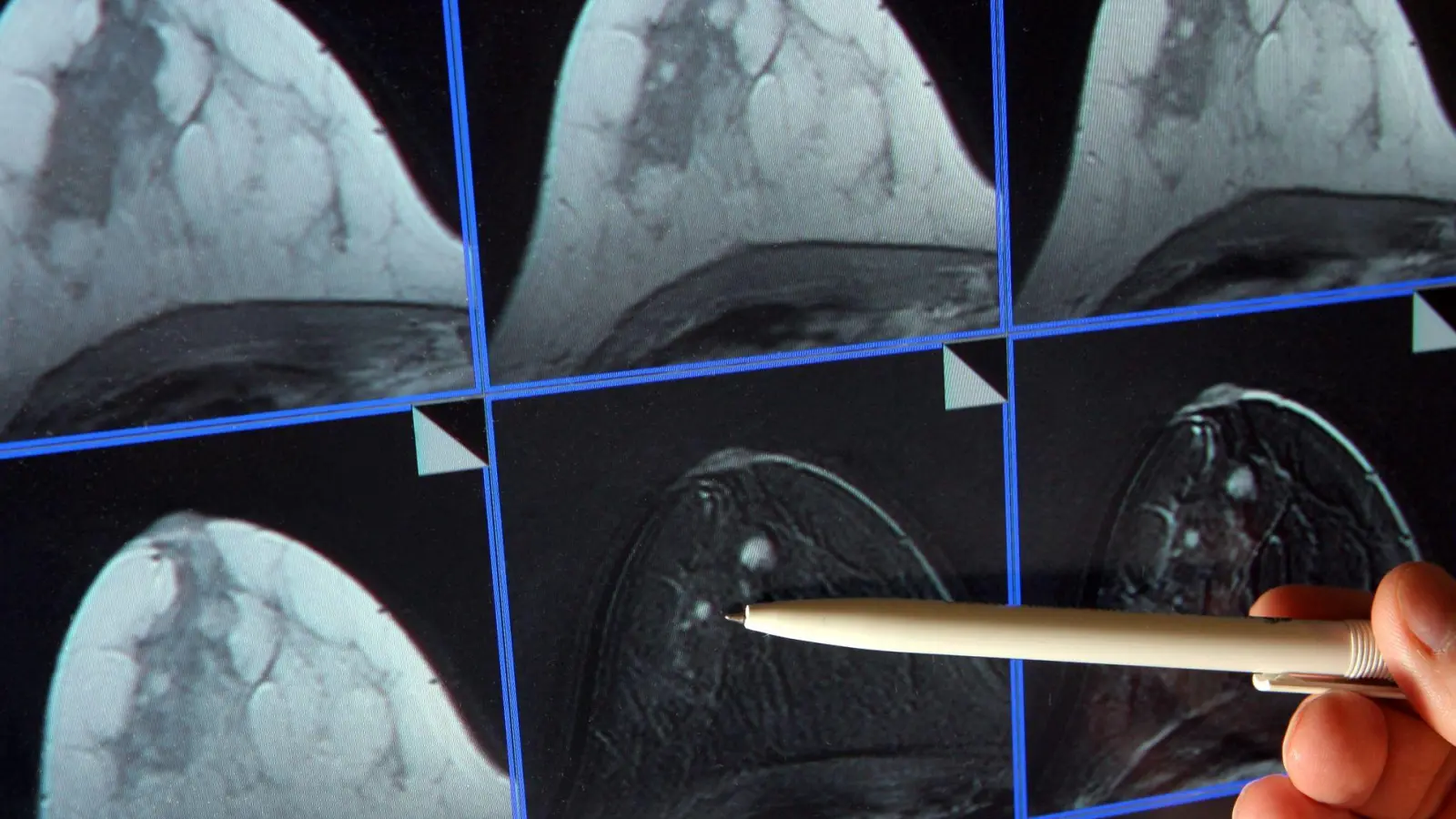 Im Zuge des Mammographie-Screening-Programms können Frauen alle zwei Jahre eine Röntgen-Untersuchung der Brust zur Früherkennung in Anspruch nehmen. (Archivbild) (Foto: Jan-Peter Kasper/dpa-Zentralbild/dpa)