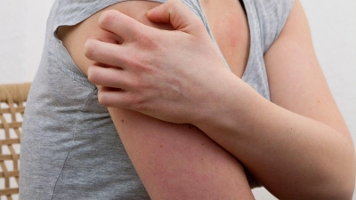 Kälte, Hitze, hormonelle Veränderungen, Infekte: Dem Auslöser einer Nesselsucht auf die Spur zu kommen, ist alles andere als einfach.  (Foto: Kai Remmers/dpa-tmn)