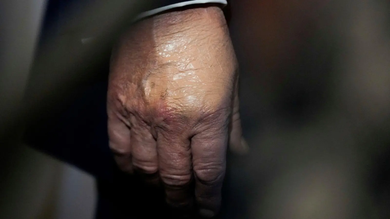 Nachdem der Bluterguss am Handrücken für Aufsehen sorgte, wurde er häufig bei Auftritten zugeschminkt. (Archivbild) (Foto: Julia Demaree Nikhinson/AP/dpa)