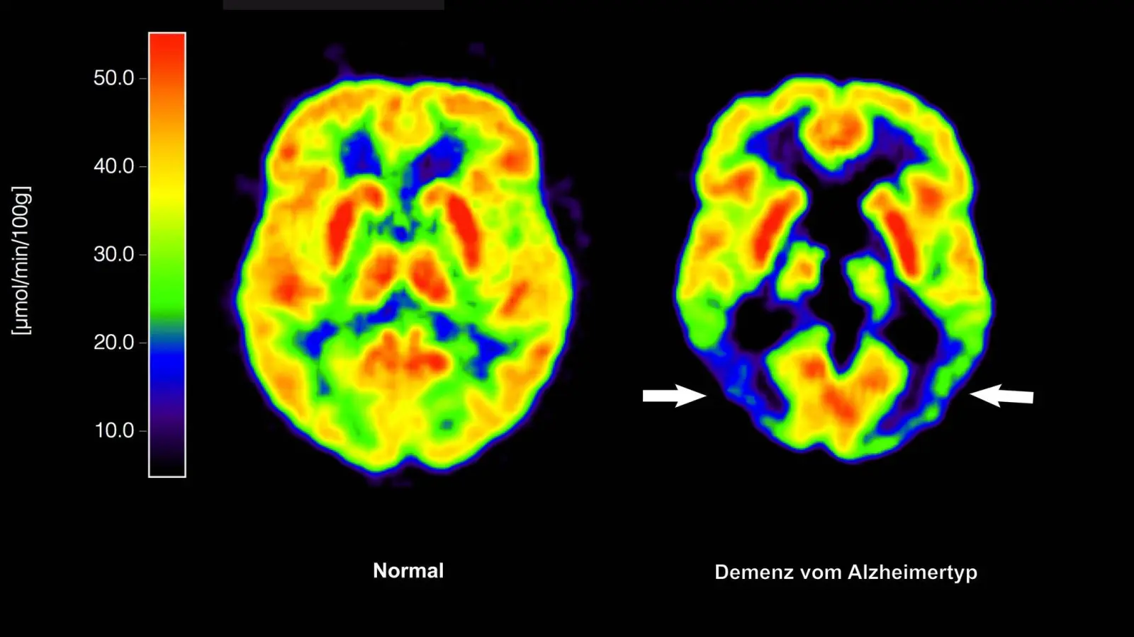 Haben die Amyloid-Plaques schon irreversible Schäden im Gehirn angerichtet, nützt ihre Entfernung nichts mehr. (Archivbild) (Foto: picture alliance / dpa)