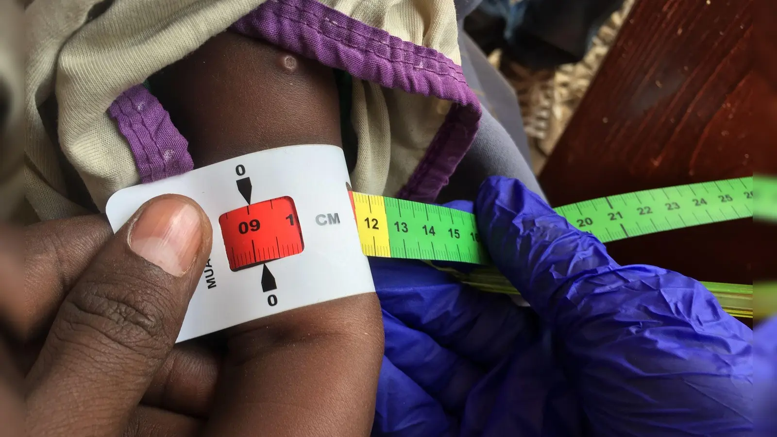 Ein Arzt misst im Sudan den Armumfang eines schwer unterernährten Babys (Archivbild) (Foto: Eva-Maria Krafczyk/dpa)