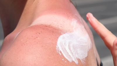 Sonnenbrand ist gefährlich - es drohen Langzeitfolgen. (Foto: Stephanie Pilick/dpa/dpa-tmn)