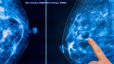 Brustkrebs stellt mit etwa 75.000 Neuerkrankungen jährlich die häufigste Krebserkrankung bei Frauen in Deutschland dar. (Archivbild) (Foto: Hannibal Hanschke/dpa)