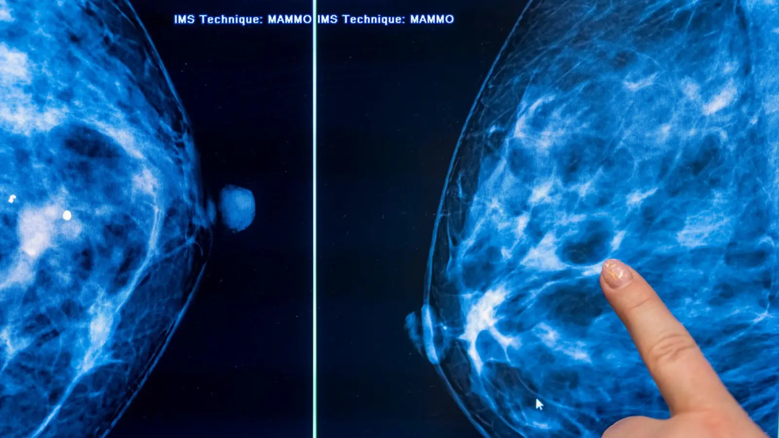 Brustkrebs stellt mit etwa 75.000 Neuerkrankungen jährlich die häufigste Krebserkrankung bei Frauen in Deutschland dar. (Archivbild) (Foto: Hannibal Hanschke/dpa)