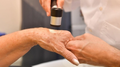 Dermatologische Praxen bieten verschiedene Methoden an, um Altersflecken dauerhaft zu entfernen. (Foto: Uli Deck/dpa-tmn)